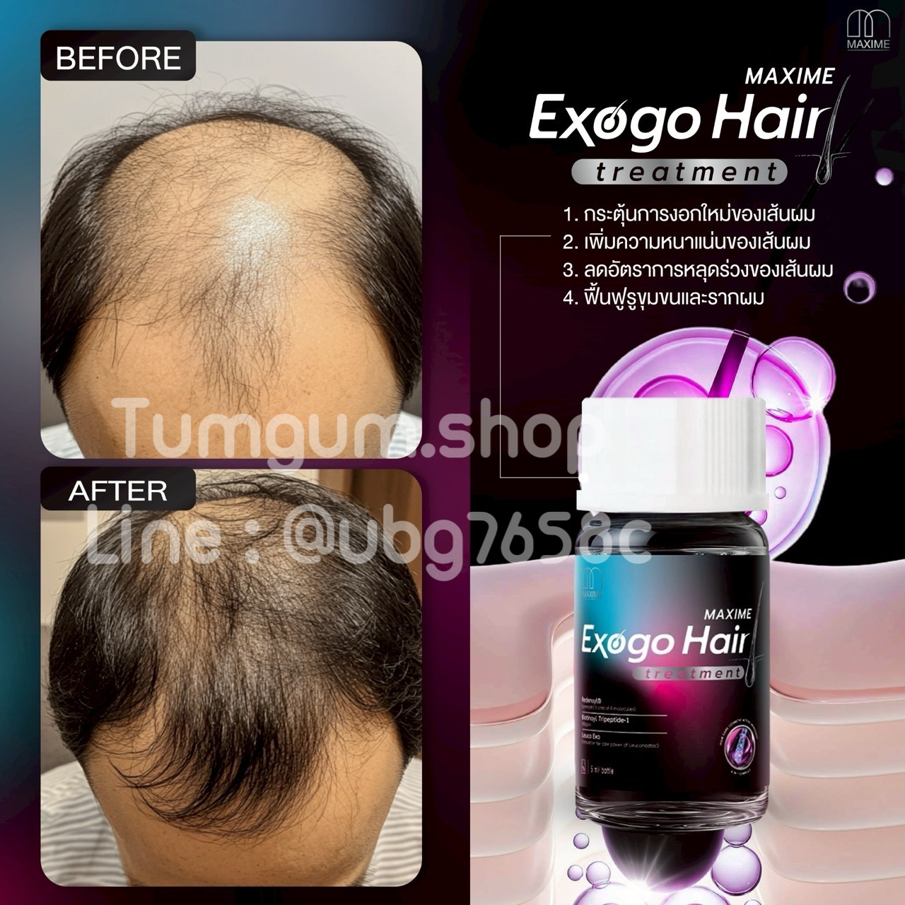 EXOGO HAIR by MAXIME บำรุงผมร่วง ผมบาง หัวล้าน (ผ่าน อย.)