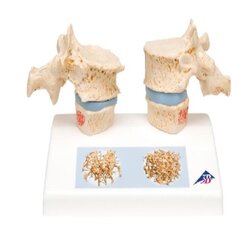 Osteoporosis Model
