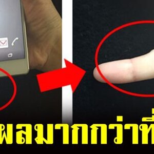 เตือนก่อนสาย อาการนิ้วก้อยผิดรูป เพราะถือสมาร์ทโฟน ส่งผลมากกว่าที่คิด